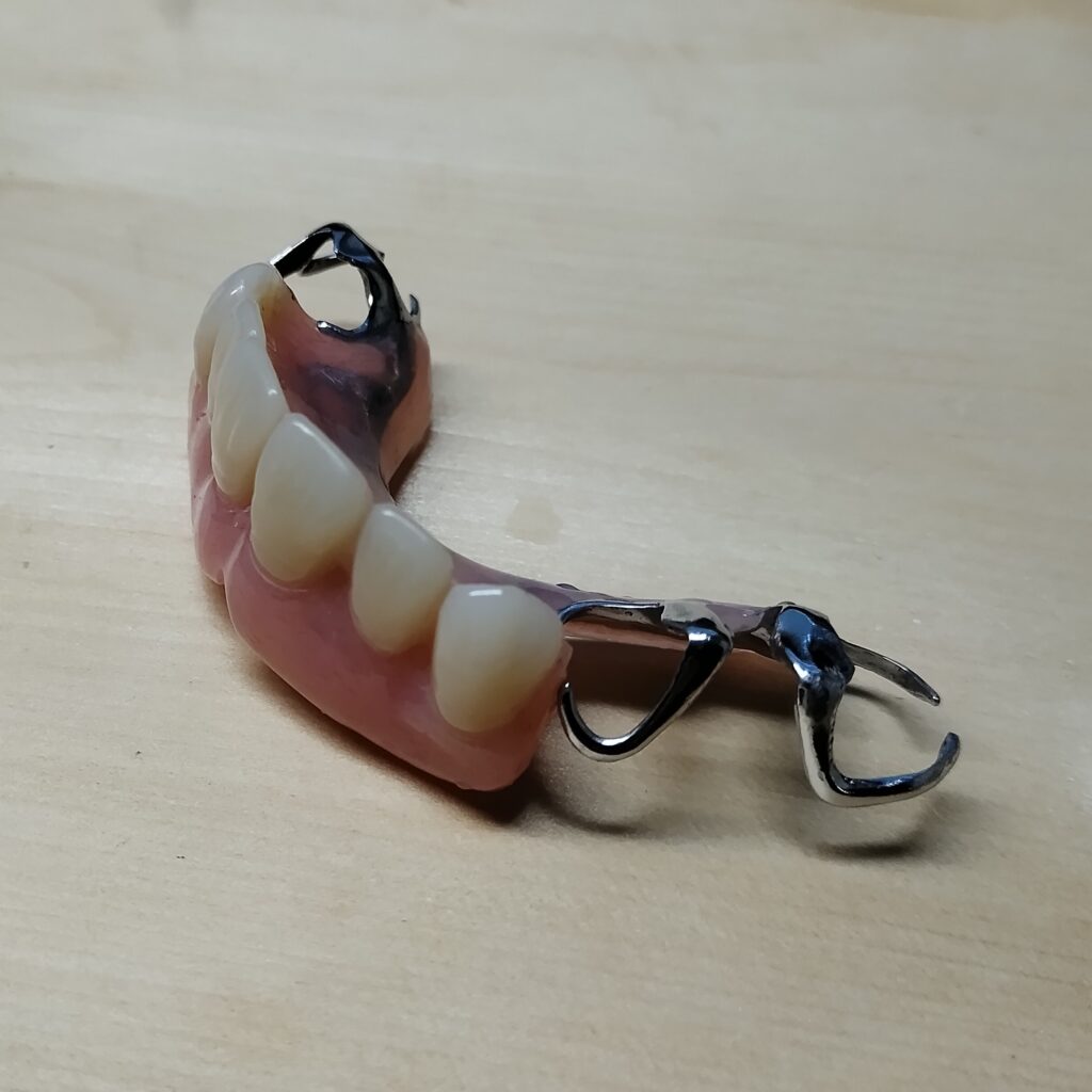 ２０２６年１月　（新製）上顎の入れ歯　部分入れ歯　パーショルデンチャー